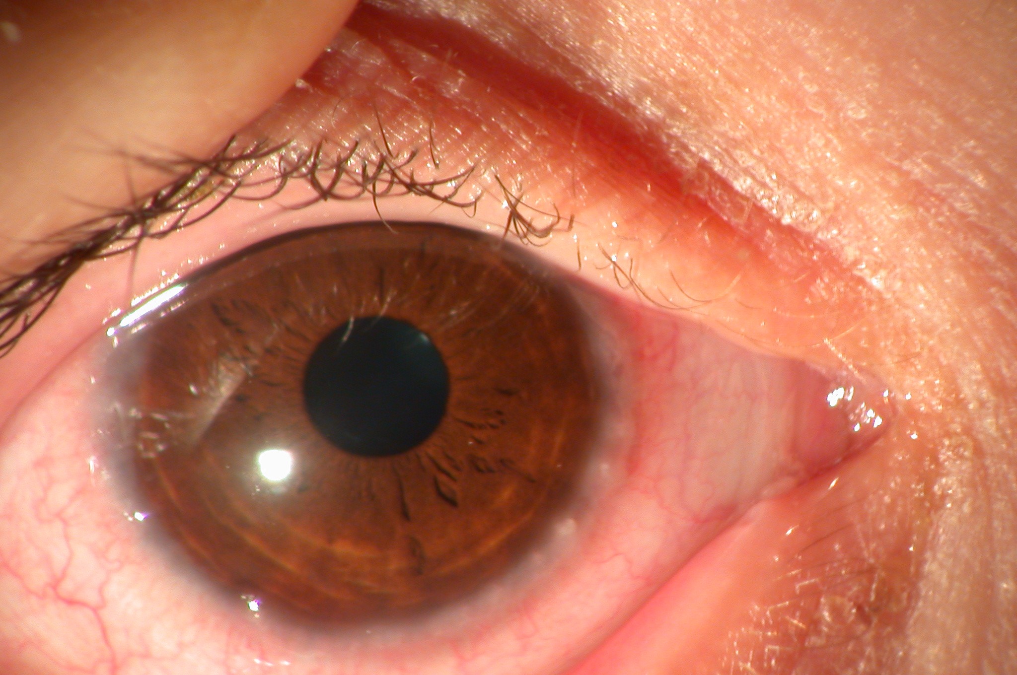 vernal-keratoconjunctivitis-vkc-www-ocular-surface